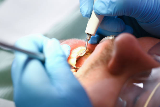 Best Knocked-Out Tooth (Avulsed Tooth) Treatment in Marks, MS